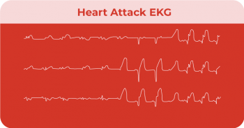 What does a Heart Attack look like on an EKG? - CardiacDirect