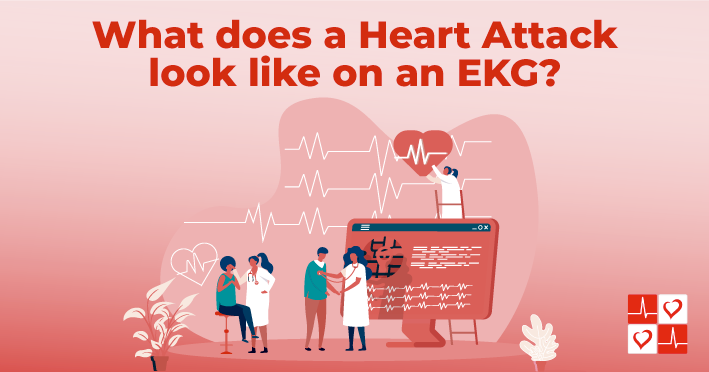 What Does A Heart Attack Look Like On An EKG CardiacDirect